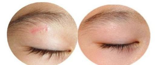 上海顴弓手術哪家醫(yī)院效果好，專家推薦