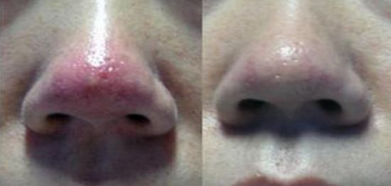 2023年浙江地區(qū)雙眼皮手術(shù)哪家醫(yī)院好，專屬權(quán)威排行榜