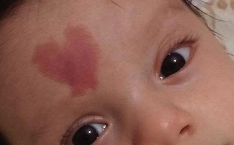 肖開(kāi)宇修復(fù)雙眼皮的方法淺析，成都知名整形醫(yī)生成功案例分享！