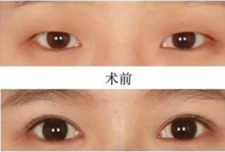 昆明哪家醫(yī)院做熱瑪吉好？挑選昆明熱瑪吉治療專業(yè)的醫(yī)院指南