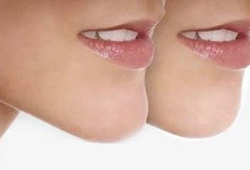 河南唇腭裂休復哪家好？專業(yè)醫(yī)院推薦及成功案例分享