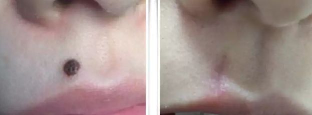 福州割眼袋醫(yī)院排行榜2023：哪家醫(yī)院割眼袋好？