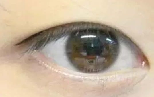 揭曉2023年武漢哪家醫(yī)院割雙眼皮好，專家推薦及真實案例！