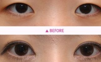 洛陽哪家雙眼皮醫(yī)院專業(yè)又靠譜？