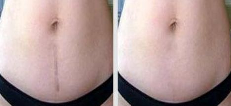 聊城激光祛痘醫(yī)院哪家好？選擇聊城最適合你的激光祛痘醫(yī)院