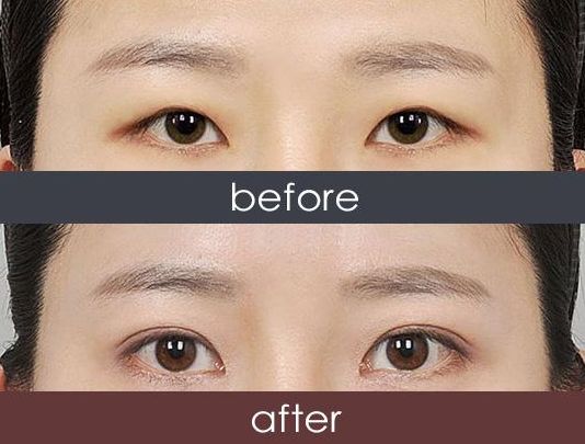 福州哪家醫(yī)院激光祛雀斑效果好？