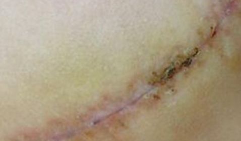 太原疤痕醫(yī)院排名哪家好？解密太原疤痕治療領(lǐng)域中的第一名