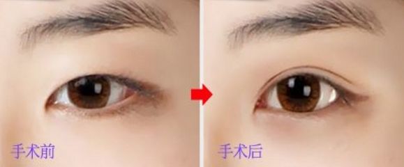 上海玻尿酸豐唇哪家醫(yī)院好？挑選上?？诒玫牟Ｄ蛩嶝S唇醫(yī)院