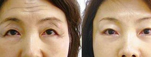 2023湖州肉毒素除眼部細(xì)紋正規(guī)專家排名TOP10強(qiáng)(曹士華、羅樂(lè)、聶益軍這幾家醫(yī)生實(shí)力口碑絕絕子！)