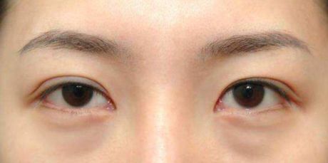 昆明做雙眼皮手術(shù)好的醫(yī)院有哪些？