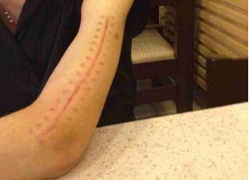 哈爾濱疤痕醫(yī)院哪家好？2023最新排名及患者口碑綜合分析