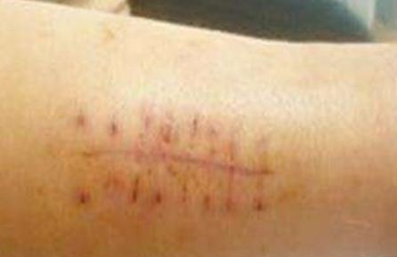 重慶治療雀斑靠譜的醫(yī)院有哪些？