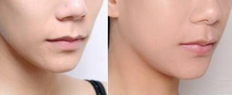 沈陽朱石江顴骨整形手術(shù)具有良好效果？詳解醫(yī)生推薦報(bào)道！