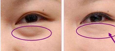 東莞豐胸醫(yī)生名單推薦！權威醫(yī)師梁如光、鄭志敏等值得信賴