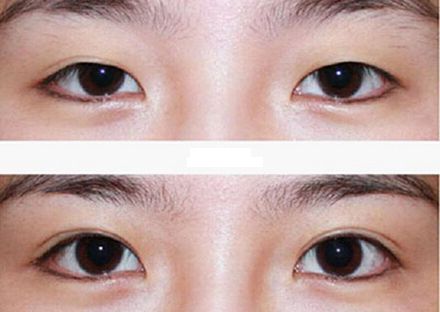 【2023年蘭州歪脖子手術(shù)哪家好？專家推薦+真實案例分析】