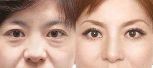 成都做乳暈漂紅哪家好？乳暈漂紅的價格、效果、方法哪種最合適？