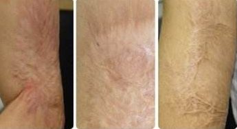 【2023廈門】專業(yè)廈門埋線減肥醫(yī)院哪家口碑好？