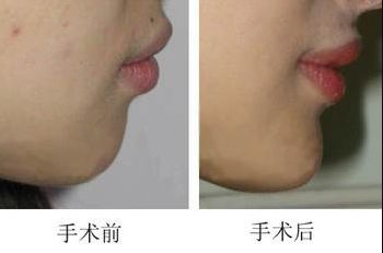 昆明哪家醫(yī)院做上臉下垂手術(shù)好，醫(yī)生技術(shù)靠譜？