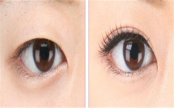 徐州雙眼皮手術(shù)哪家醫(yī)院好？推薦經(jīng)驗(yàn)豐富的專業(yè)醫(yī)療機(jī)構(gòu)！