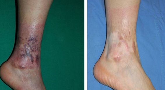 上海手術(shù)點痣醫(yī)院哪家好？揭秘上海最受歡迎的點痣醫(yī)院