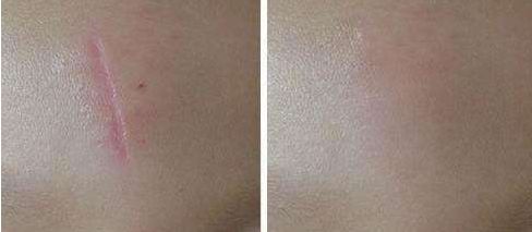 深圳哪家醫(yī)院脂肪豐胸效果好？