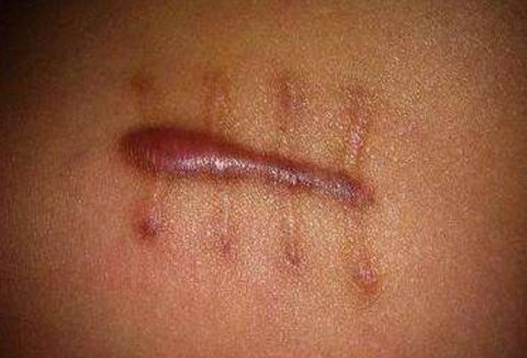 西安熱瑪吉醫(yī)院哪家好？揭曉西安市優(yōu)秀的熱瑪吉治療機(jī)構(gòu)