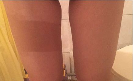 山東哪家醫(yī)院治療疤痕好？挑選最適合您的醫(yī)療機構！