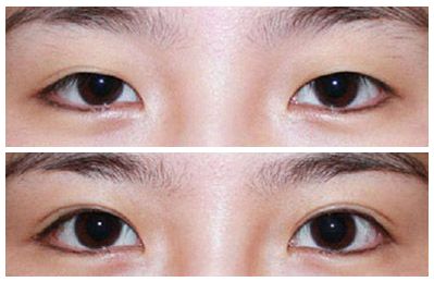 2023安徽韓式三點(diǎn)雙眼皮權(quán)威專家排名前十(劉愛國、王凱、朱飛口碑評價(jià)都很高)