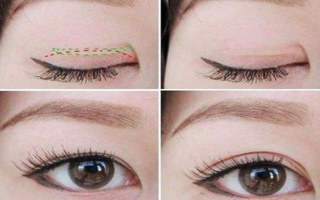 上海打臥蠶哪家醫(yī)院好？選擇上海治療臥蠶一流的醫(yī)院