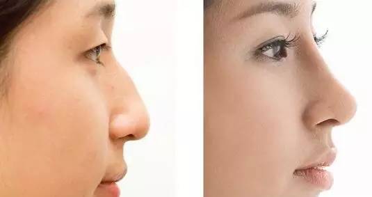 2023中山八大處做隆鼻排名榜前十名醫(yī)生(鐘宏宇、許琴、顏玲正規(guī)專家包你滿意)