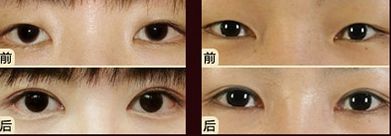 嘟嘟唇無錫哪家醫(yī)院好？專家推薦無錫哪家醫(yī)院治療嘟嘟唇好