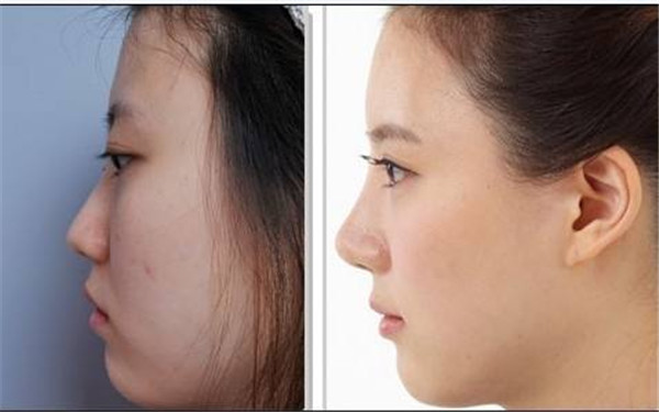 尹寧北唇裂的治療方法與修復(fù)手術(shù)現(xiàn)場展示！擁有自信笑容的秘訣！