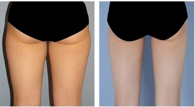 福州哪家醫(yī)院的臉部拉皮手術(shù)效果好