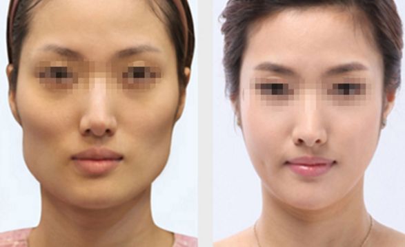 長春雙眼皮修復好的醫(yī)院有哪些？