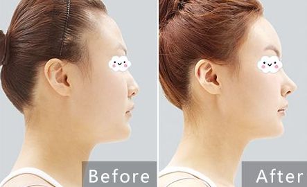 貴陽(yáng)治療痘坑哪家醫(yī)院專(zhuān)業(yè)可靠？