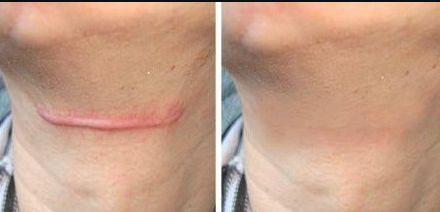 成都市開眼角醫(yī)院哪家好？選擇適合你的開眼角醫(yī)院