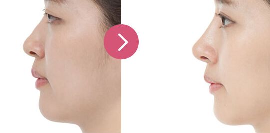 揚(yáng)州私密整形哪家好？專業(yè)推薦！