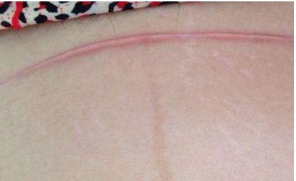 福州哪家醫(yī)院打玻尿酸效果好？