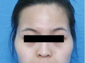 成都治療臉上痘痘哪家醫(yī)院好？專家推薦的成都治痘好醫(yī)院大揭秘！