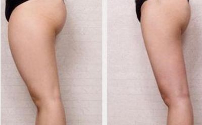 商丘做雙眼皮去哪家好？選擇最適合自己的雙眼皮整形醫(yī)院