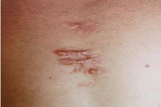 成都祛疤痕效果好的醫(yī)院有哪些？