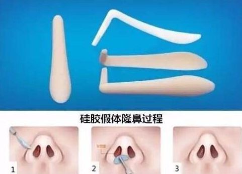 上海哪家醫(yī)院祛斑去痣好？專家?guī)懔私庾钸m合你的祛斑去痣方法！