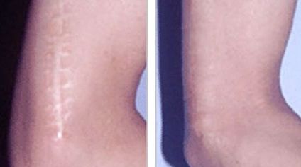 哈爾濱哪家醫(yī)院去除痘痘增生效果好，推薦給大家！