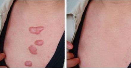 上海疤痕醫(yī)院去哪家好？專家推薦的上海疤痕治療醫(yī)院有哪些？