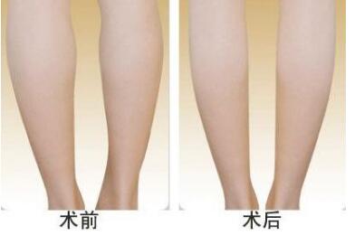 李闖隆鼻效果對比：神奇改變顏值，素顏自信重煥青春！