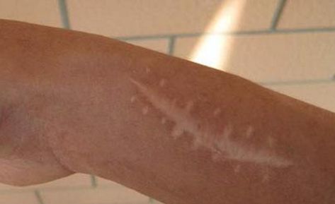 南京哪家醫(yī)院的疤痕修復(fù)效果最佳？