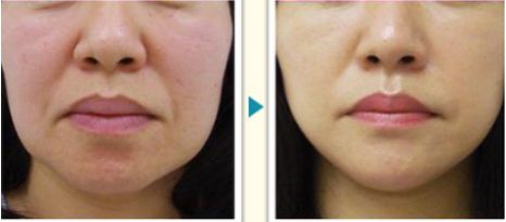 溫州激光祛痘醫(yī)院排行榜，哪家專業(yè)好評多