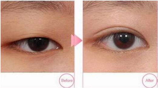 寧波哪家醫(yī)院做韓式雙眼皮效果好？