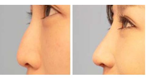 大連瑞和醫(yī)療美容醫(yī)院受歡迎嗎？楊檸澤做雙眼皮效果怎樣？真實(shí)網(wǎng)友體驗(yàn)來了解！