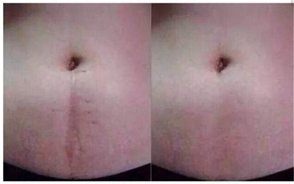 深圳哪家醫(yī)院專業(yè)治療傷疤效果好？